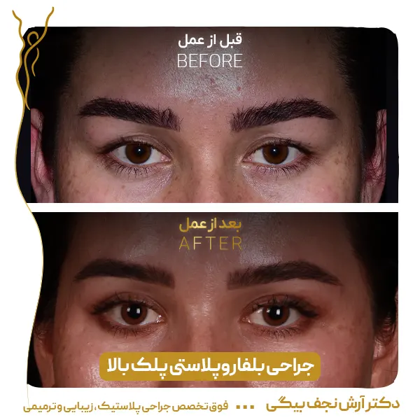 نمونه قبل و بعد جراحی پلک 1