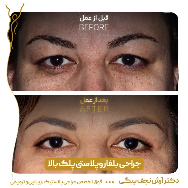 نمونه قبل و بعد جراحی پلک 2