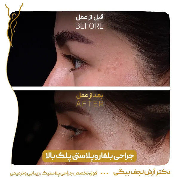 نمونه قبل و بعد جراحی پلک 3