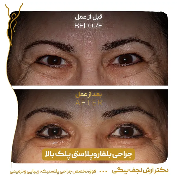 نمونه قبل و بعد جراحی پلک 4
