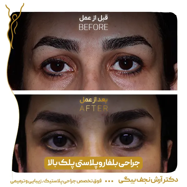 نمونه قبل و بعد جراحی پلک 5