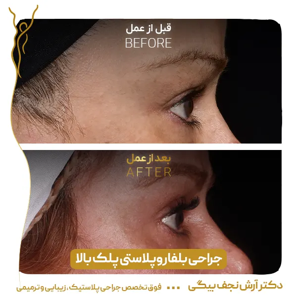 نمونه قبل و بعد جراحی پلک 6