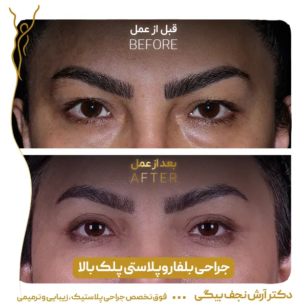 نمونه قبل و بعد جراحی پلک 7