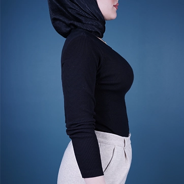 نمونه نتیجه پروتز سینه