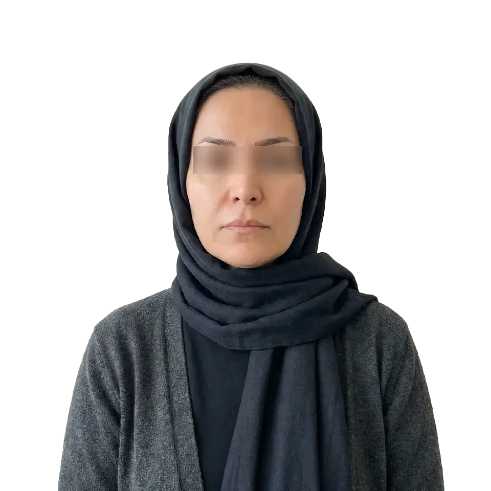 نمونه تصویر لیفت صورت 1