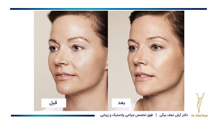 نمونه قبل و بعد تزریق چربی به صورت 1
