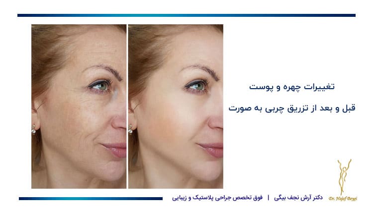 نمونه قبل و بعد تزریق چربی به صورت 3