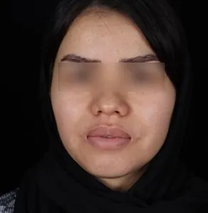 نمونه جراحی لب 1