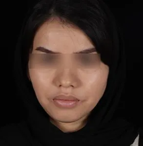 نمونه جراحی لب 2