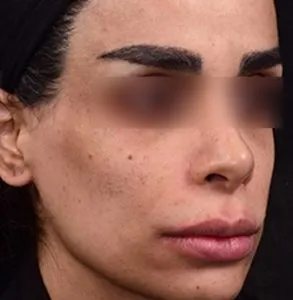 نمونه جراحی لب 3
