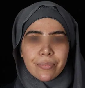 نمونه جراحی لب 5