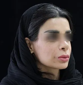 نمونه جراحی لب 6