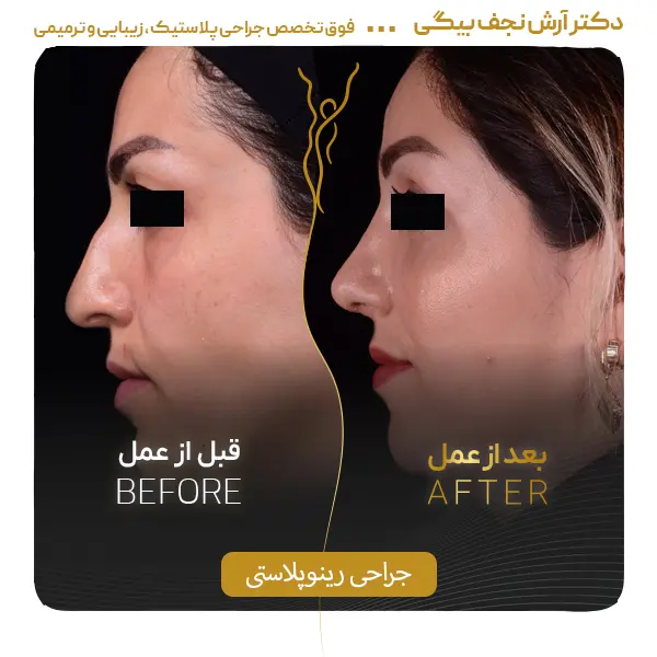 نمونه قبل و بعد جراحی بینی ۱