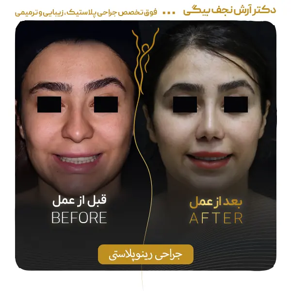 نمونه قبل و بعد جراحی بینی ۲