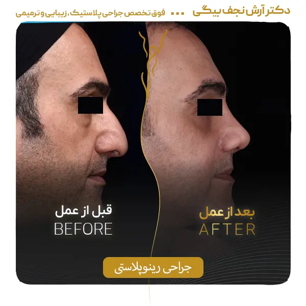 نمونه قبل و بعد جراحی بینی ۳