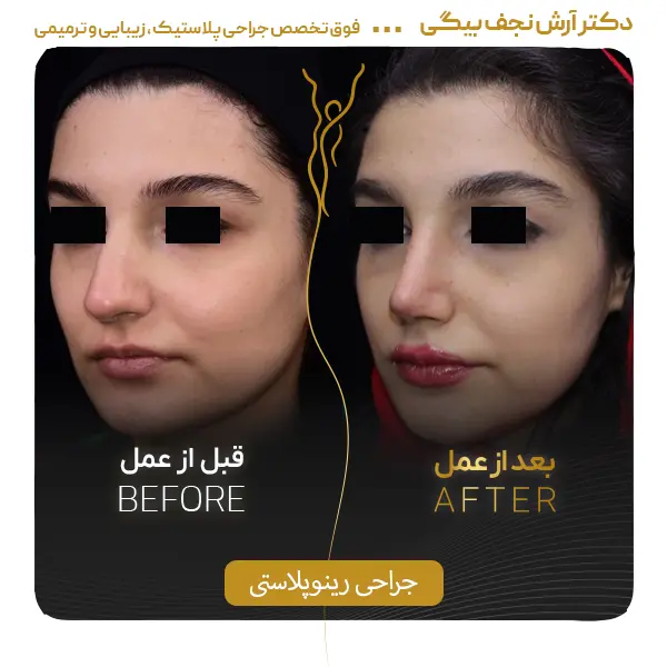 نمونه قبل و بعد جراحی بینی ۴