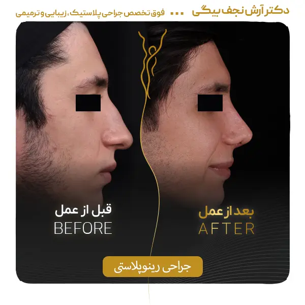 نمونه قبل و بعد جراحی بینی ۵